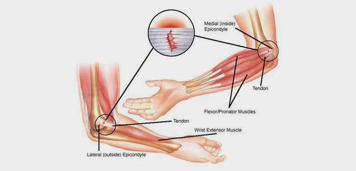 De modo general, la epicondilitis es un trastorno traumatológico que puede aparecer en las diversas articulaciones del cuerpo al realizar un esfuerzo de baja intensidad pero con muchas repeticiones.
